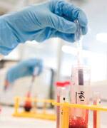 Novel Stem Cell Treatment For Scleroderma