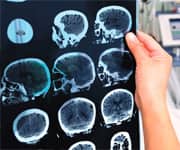 Startling Numbers Of Excess Cancers