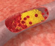 Calorie Restriction Lowers Risk Of Age-Related Diseases