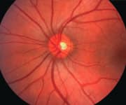 Acute Glaucoma Is An Inflammatory Disease