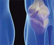 Glucosamine And Chondroitin As Effective As Celebrex® In Some Osteoarthritis Patients