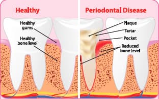 Healthy and Diseased Teeth and Gums