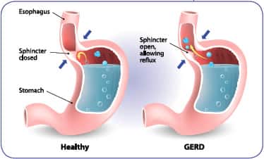 GERD, Proton Pump Inhibitors, and Long-Term Health