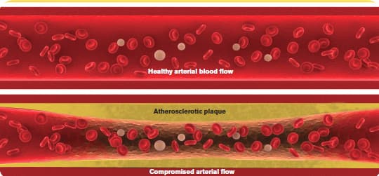 How Pycnogenol® Benefits Coronary Artery Disease