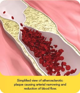 Reduced Risk of Progression of Plaques