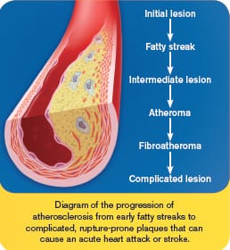 Impact on Advanced Atherosclerosis