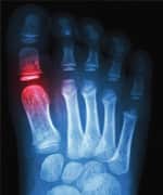 Understanding Gout