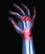 Lowering Uric Acid Levels