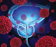 Lower Screening Rates Could Delay Early Onset Prostate Cancer Treatment