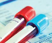 Blood Test Predicts Second Stroke Risk