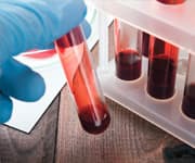 Prostate Cancer Deaths Sharply Higher in United Kingdom