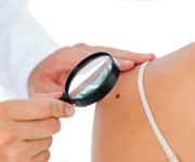 Types of Skin Cancers