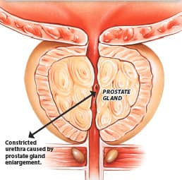 Breakthrough Prostate Cancer Testing and Treatment