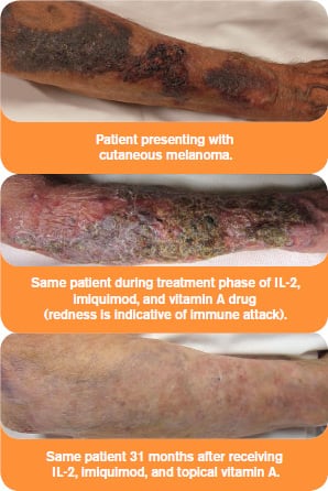 Results with Yervoy® and Keytruda®