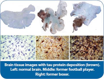Traumatic Brain Injury Often Goes Untreated
