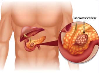 Pancreatic Cancer