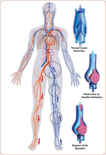 Thromboembolism