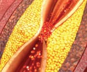 After-Meal Fat Damages Arterial Walls