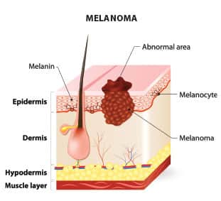 The Escalating Skin Cancer Epidemic