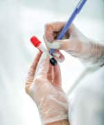 Homocysteine Blood Testing