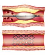Homocysteine Increases Heart Risks
