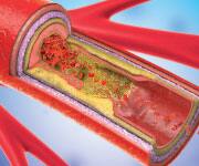 Calcification of coronary artery.