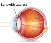 How Cataracts are Formed