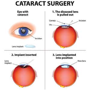 Cataract Surgery