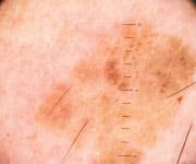 Sun Exposure Destroys Skin Cells