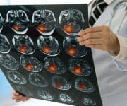 Stroke Prevention Far More Effective
