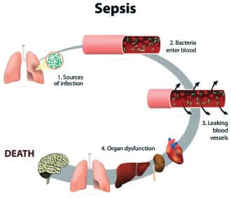 Sepsis