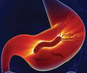 The bacterium Helicobacter pylori is a major cause of ulcers, gastritis, and stomach cancer.