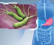 Lactobacillus reuteri Eradicates H. pylori