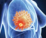 Genetically Altering Breast Cancer Cells