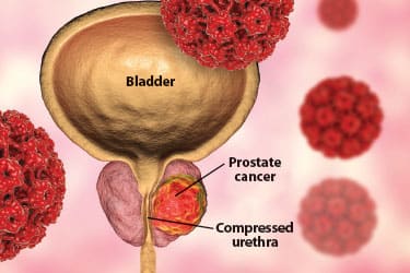 Artist rendition of Bladder and prostate cancer