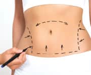 tummy tuck