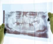 Dental X-rays