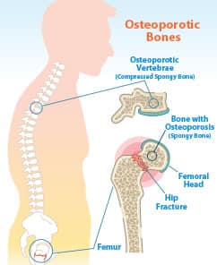 Osteoporotic chart