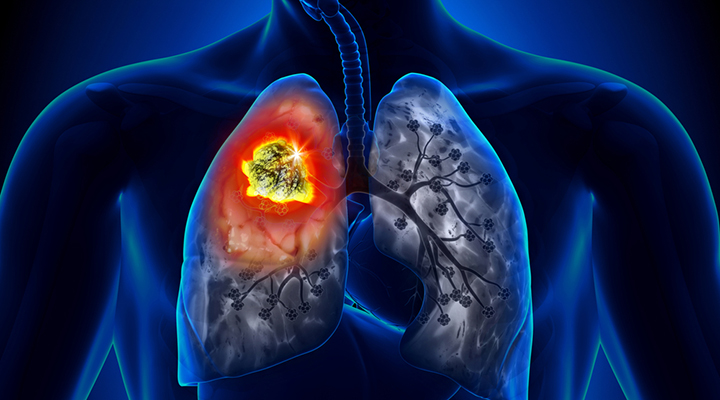Image result for lung cancer images
