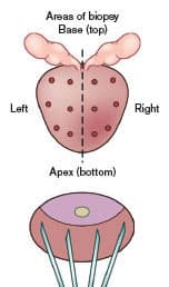 12 core prostate needle boipsy