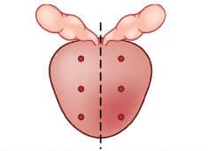 Prostate gland marking a 6-core needle biopsy