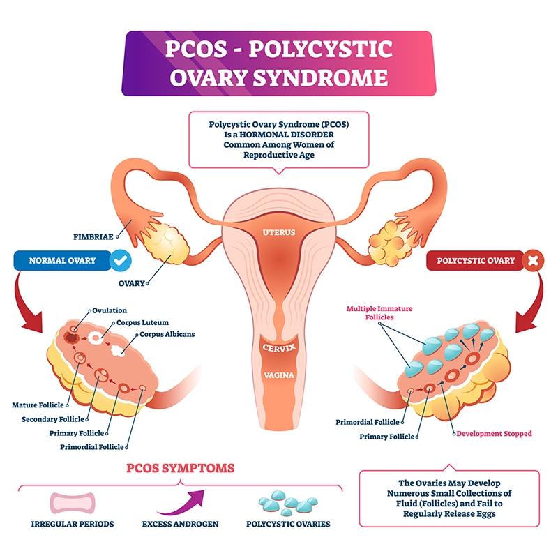 PDF] The Use of Kigelia africana in the Management of Polycystic Ovary  Syndrome (PCOS)