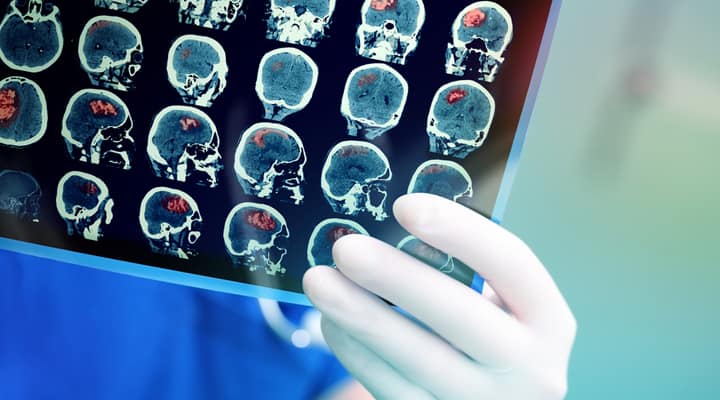How to Keep Your Brain from Shrinking - Life Extension