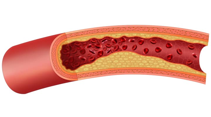 Example of blood vessel that has an excess of homocysteine