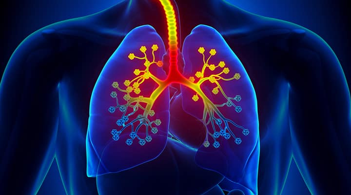 Pair of lungs with yellow and red indicating where bronchitis infect