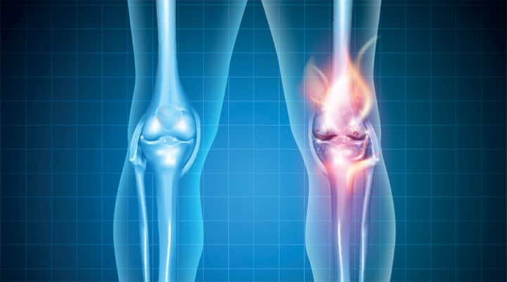 X-ray of two knee joints with one is inflamed due to gout
