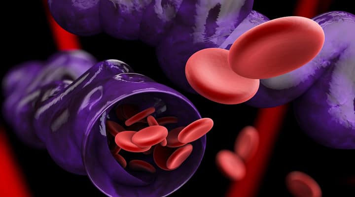 Restricted blood flow in a blood vessel from chronic venous disease