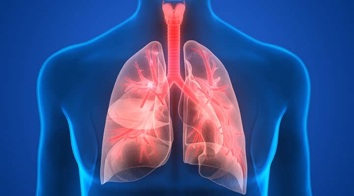 Pair of lungs that are being affected by pneumonia