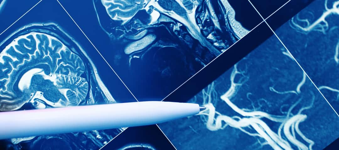 Pen pointing at brain scan