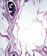 Breast carcinoma